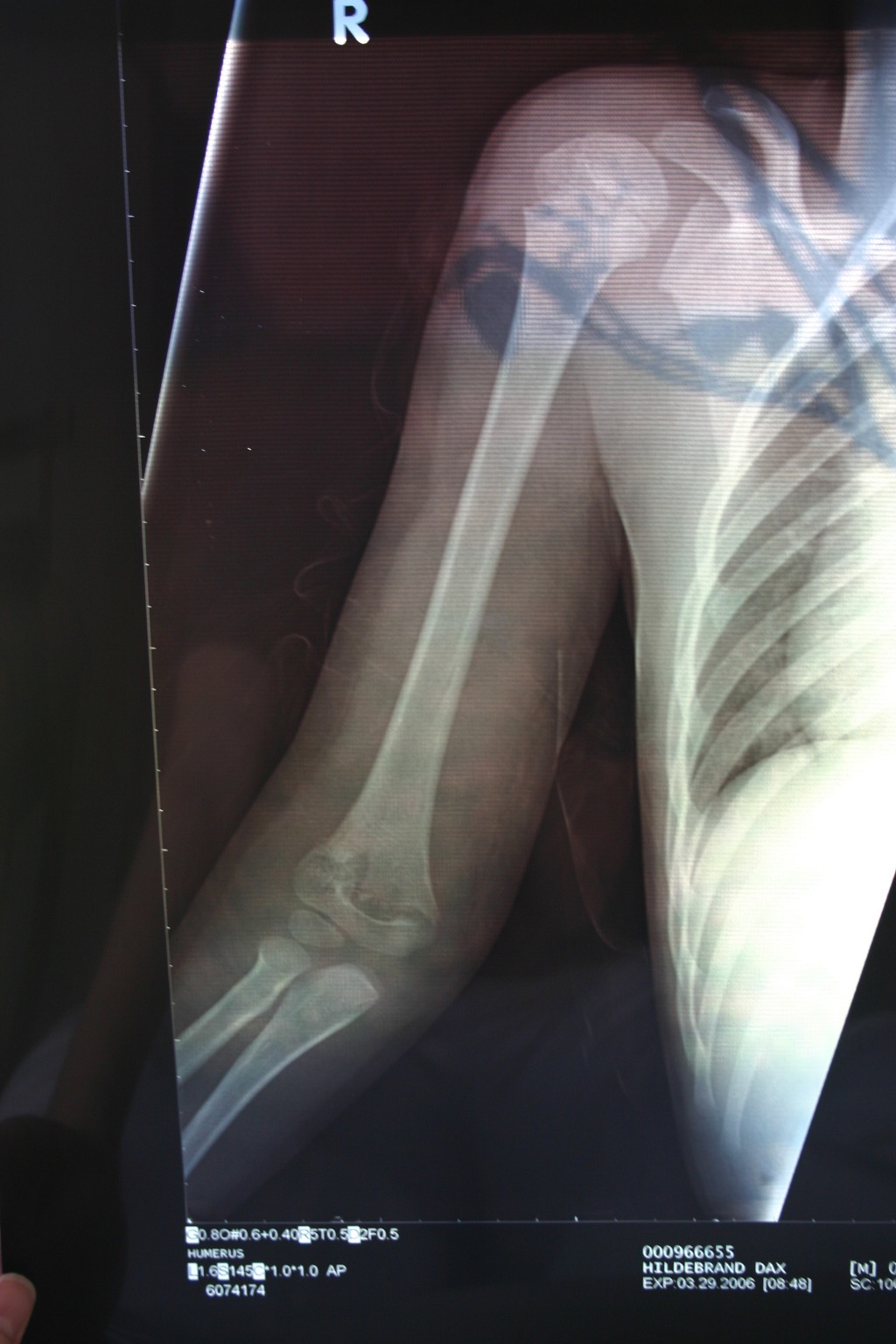 2006/03(March)/Dax-broken-arm/1024x768_2006-03-29-Dax-broken-arm-3.JPG