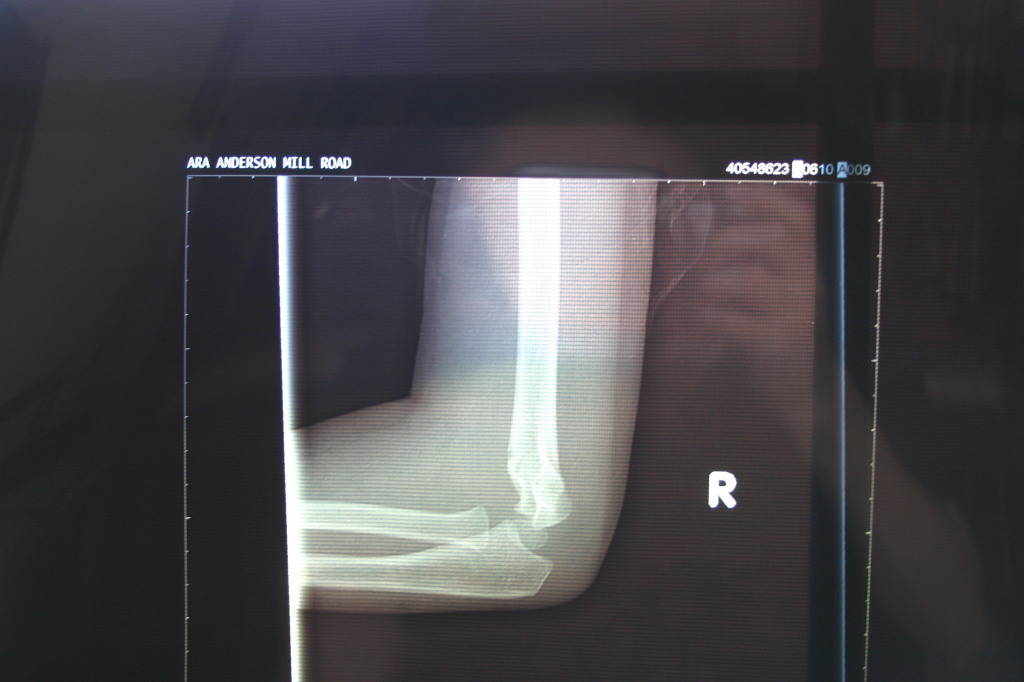 2006/03(March)/Dax-broken-arm/1024x768_2006-03-29-Dax-broken-arm-5.JPG