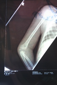 2006/03(March)/Dax-broken-arm/2006-03-29-Dax-broken-arm-1.JPG