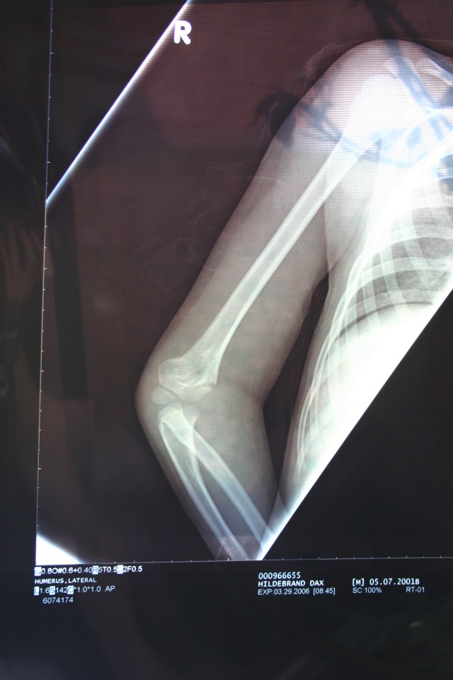 2006/03(March)/Dax-broken-arm/640x480_2006-03-29-Dax-broken-arm-1.JPG