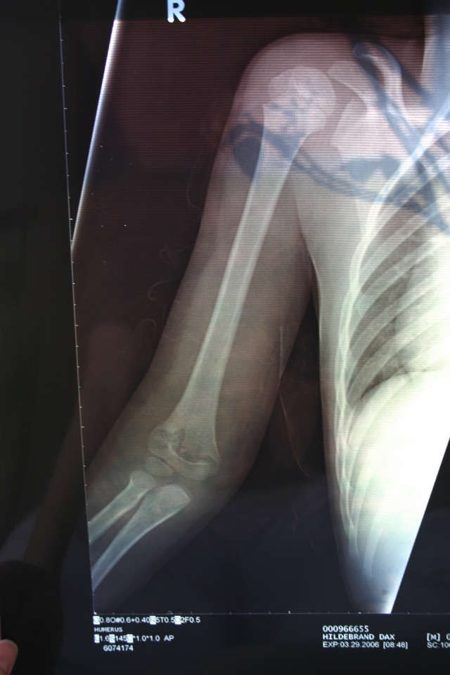 2006/03(March)/Dax-broken-arm/640x480_2006-03-29-Dax-broken-arm-3.JPG