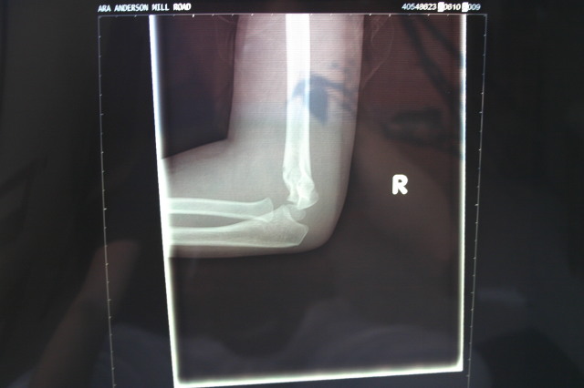 2006/03(March)/Dax-broken-arm/640x480_2006-03-29-Dax-broken-arm-4.JPG