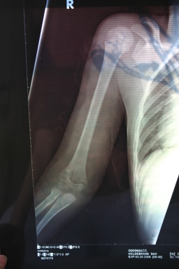 2006-03-29-Dax-broken-arm-3.JPG