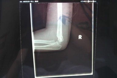 2006-03-29-Dax-broken-arm-4.JPG
