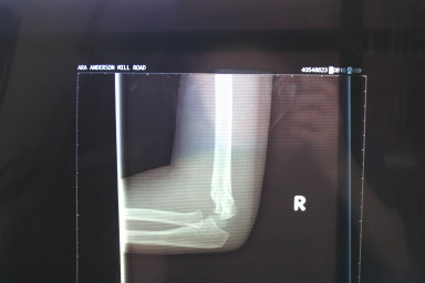 2006-03-29-Dax-broken-arm-5.JPG