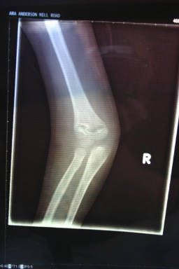 2006-03-29-Dax-broken-arm-7.JPG