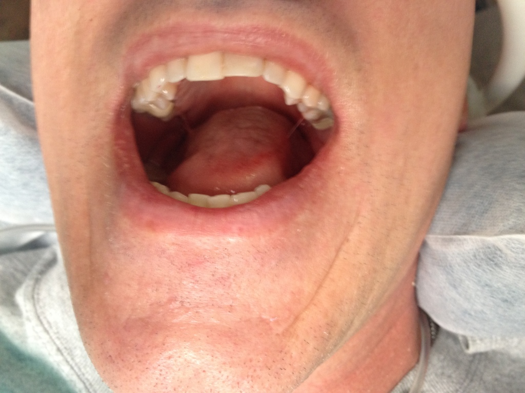 2014/07(July)/Travis-2-crowns/2014-07-22-Travis-Two-Crowns-Dentist-1.JPG