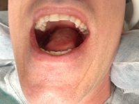 2014/07(July)/Travis-2-crowns/2014-07-22-Travis-Two-Crowns-Dentist-1.JPG