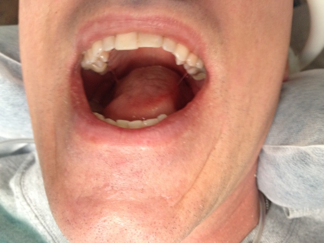 2014/07(July)/Travis-2-crowns/2014-07-22-Travis-Two-Crowns-Dentist-1.JPG