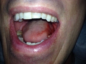2014-07-22-Travis-Two-Crowns-Dentist-2.JPG