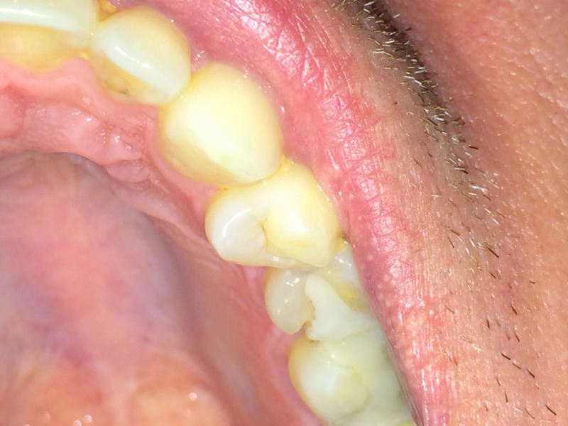 2015/04(April)/Misc/800x600_2015-04-17-Travis-chipped-tooth.JPG