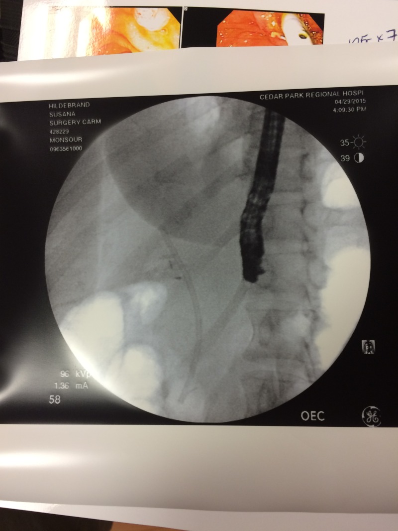 2015/04(April)/Suzi-Gall-Bladder-surgery/800x600_2015-04-29-Suzi-Gall-Bladder-Surgery-4.JPG