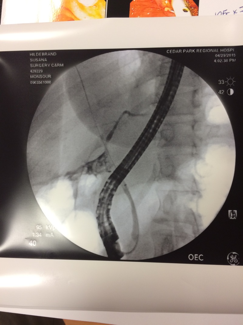 2015-04-29-Suzi-Gall-Bladder-Surgery-5.JPG