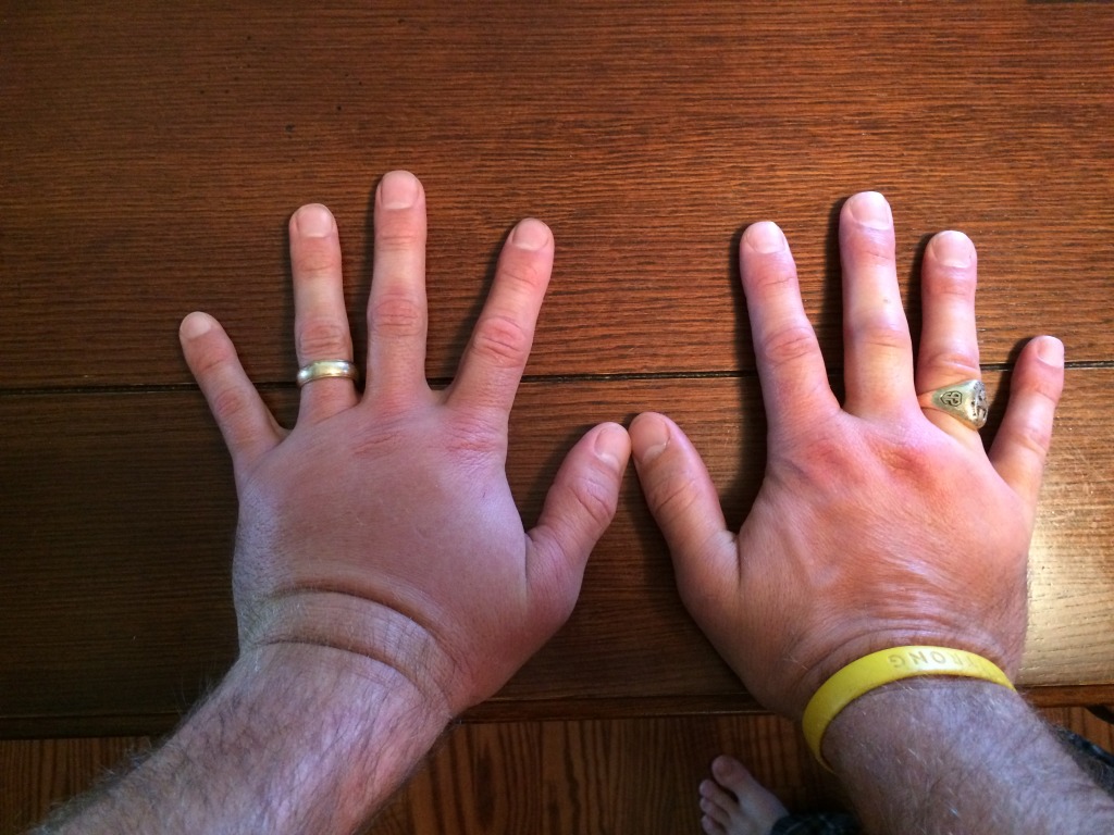 2015/06(June)/Misc/1024x768_2015-06-01-Travis-wasp-sting-on-both-hands-1.JPG