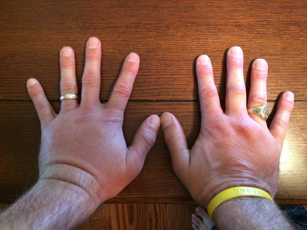 2015/06(June)/Misc/1024x768_2015-06-01-Travis-wasp-sting-on-both-hands-2-GOOD.JPG