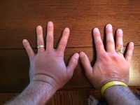 2015/06(June)/Misc/2015-06-01-Travis-wasp-sting-on-both-hands-1.JPG