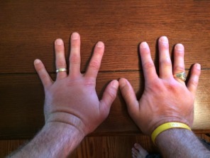 2015-06-01-Travis-wasp-sting-on-both-hands-1.JPG