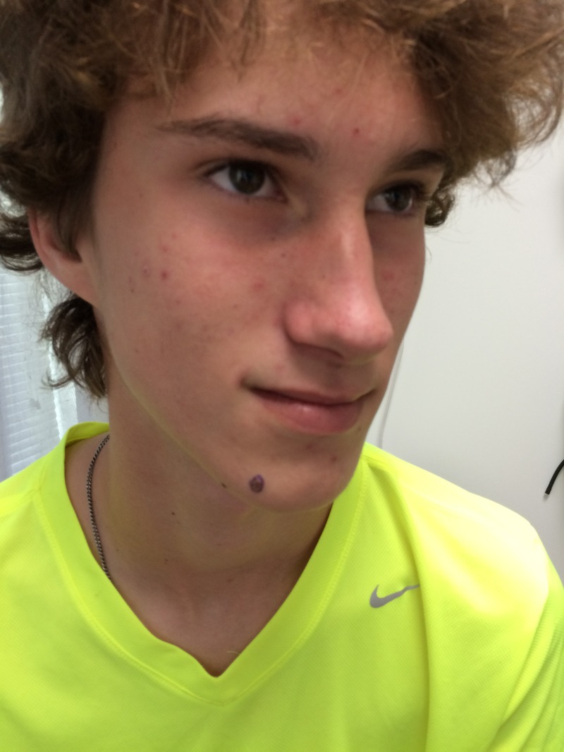 2015/07(July)/Misc/800x600_2015-07-15-Chance-mole-removal-2.JPG