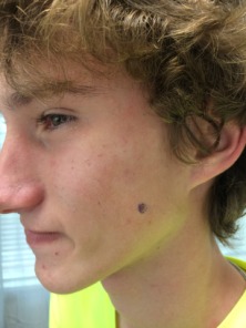 2015-07-15-Chance-mole-removal-1.JPG