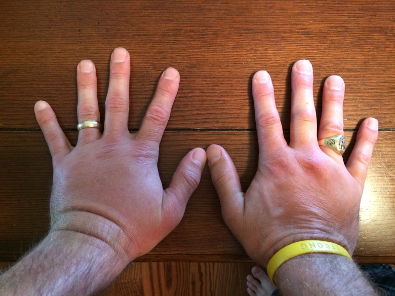 2015/BEST-OF/800x600_2015-06-01-Travis-wasp-sting-on-both-hands-2-GOOD.JPG