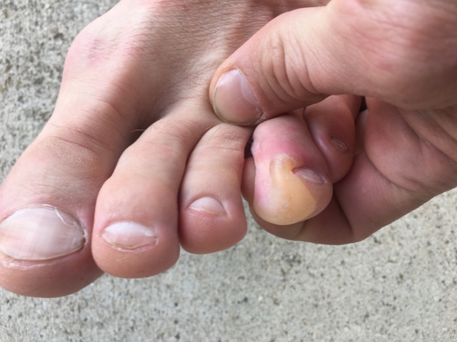 2016-03-24-Appalachian-Trail-021-Chaos-blister.JPG