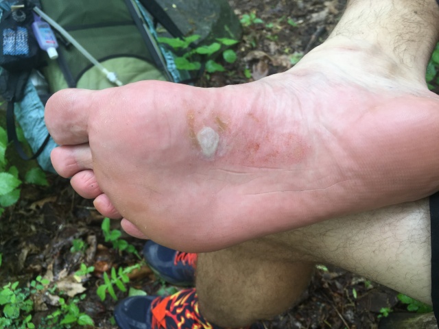 2016-05-10-Appalachian-Trail-198-Bevo-bottom-of-foot-blister.JPG