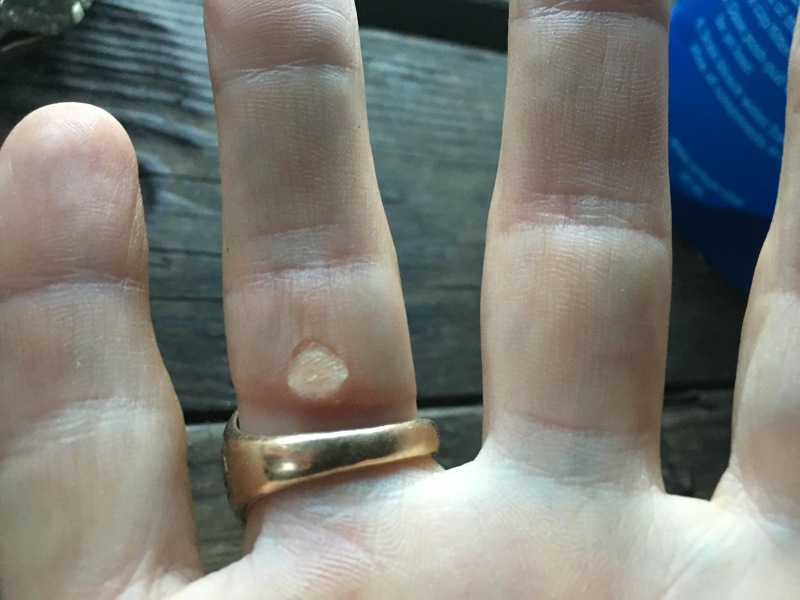 2016-03-29-Appalachian-Trail-045-Bevo-1st-blister-on-hand-from-paddling.JPG