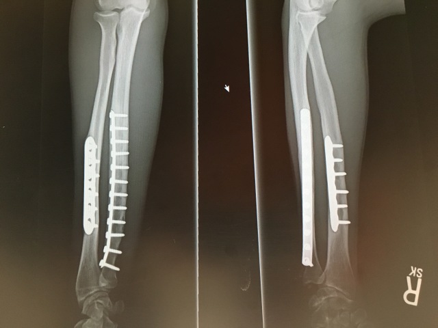 2016-09-14-Chance-Broken-Arm-Three-2.JPG