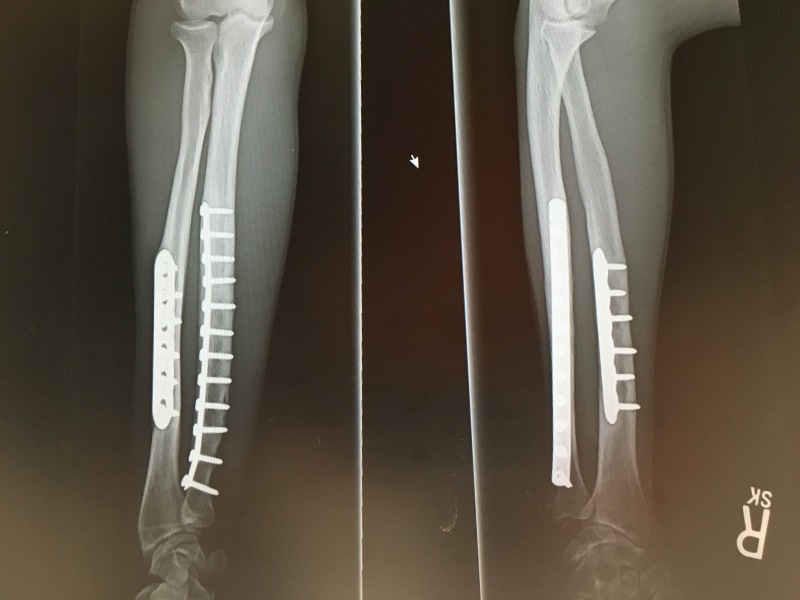2016-09-14-Chance-Broken-Arm-Three-2.JPG