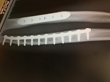 2016-09-14-Chance-Broken-Arm-Three-1.JPG