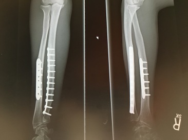 2016-09-14-Chance-Broken-Arm-Three-2.JPG