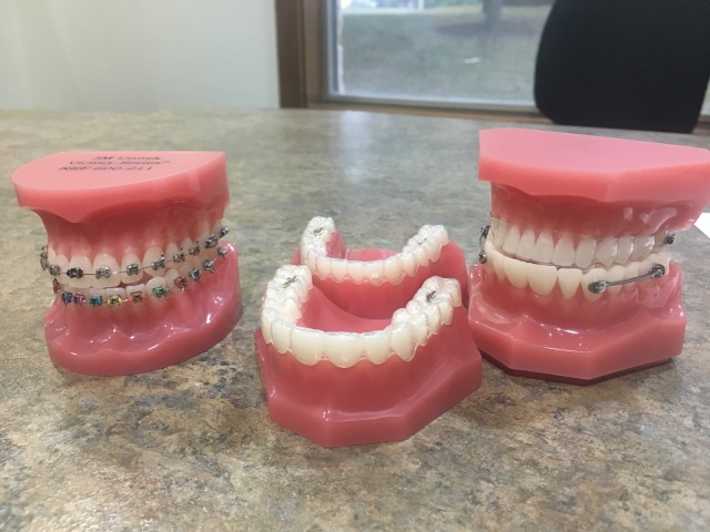 2017-11-02-Chance-Braces-1.JPG