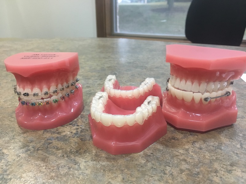 2017-11-02-Chance-Braces-1.JPG