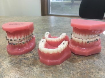 2017-11-02-Chance-Braces-1.JPG