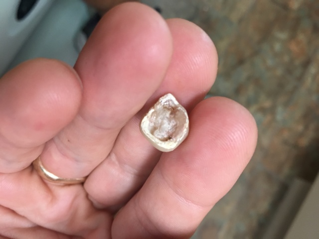 2018/04(April)/Misc/640x480_2018-04-26-Travis-broken-tooth-crown-1.JPG