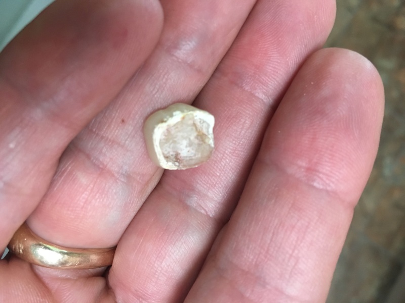 2018-04-26-Travis-broken-tooth-crown-2.JPG