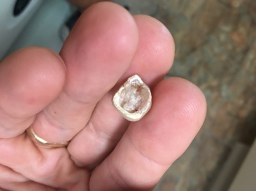 2018-04-26-Travis-broken-tooth-crown-1.JPG