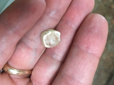 2018-04-26-Travis-broken-tooth-crown-2.JPG