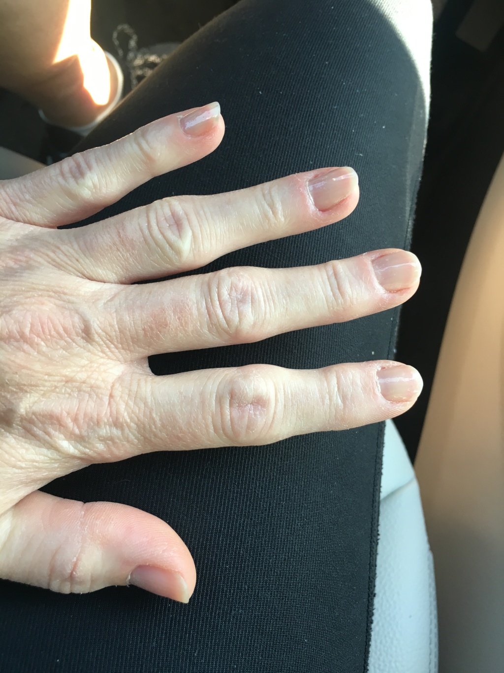 2018/07(July)/Misc/1024x768_2018-07-26-Suzi-swollen-finger-1.JPG