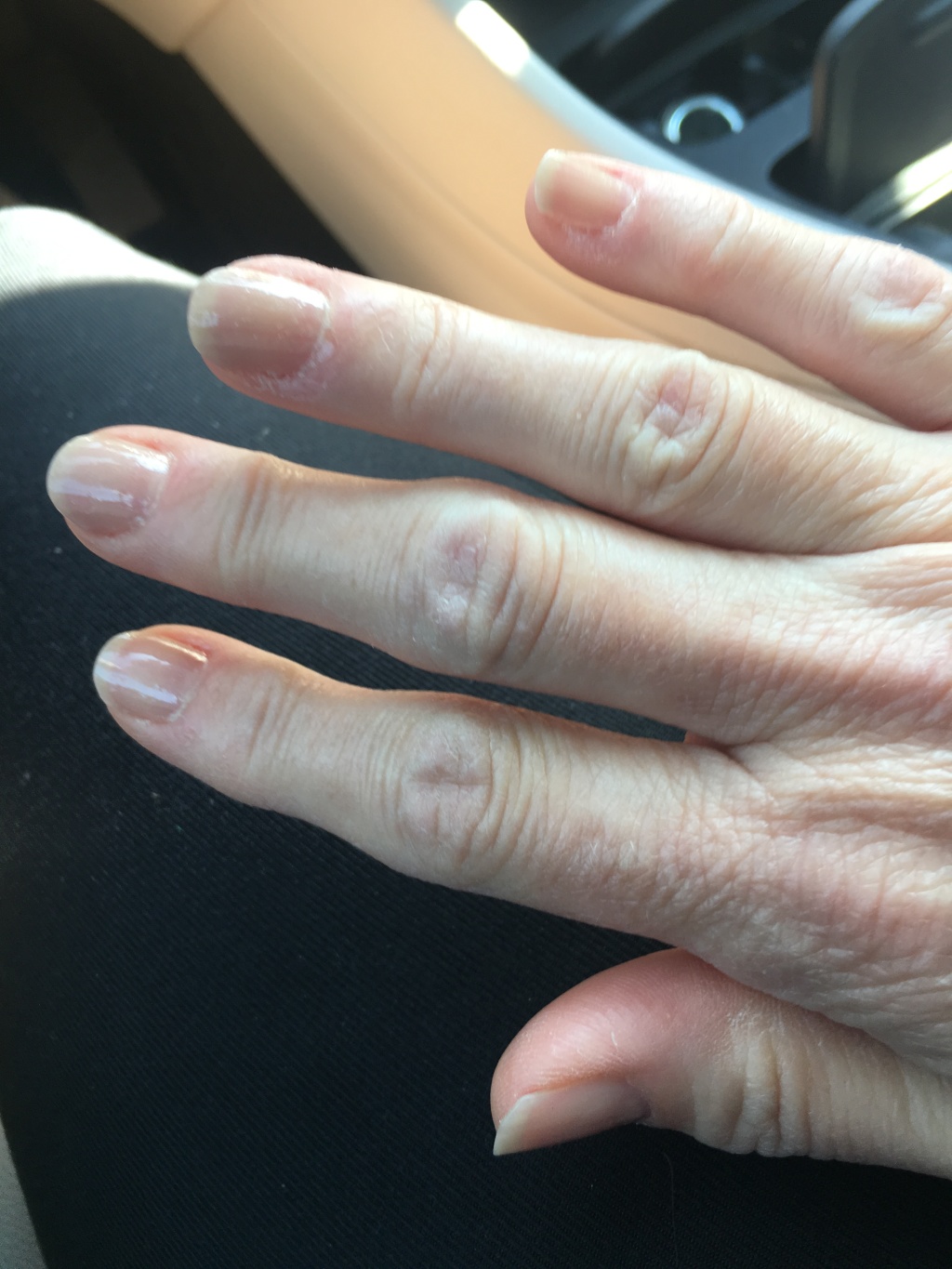 2018/07(July)/Misc/1024x768_2018-07-26-Suzi-swollen-finger-2.JPG