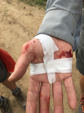 2019-06-19-Philmont-Crew8787-30-Carl-busted-hand.JPG