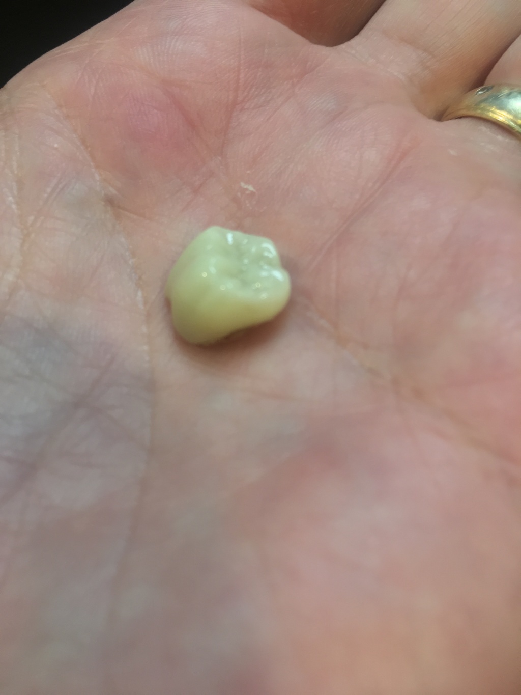 2019/09(September)/Broken-Tooth/1024x768_2019-08-20-Broken-crown-1.JPG