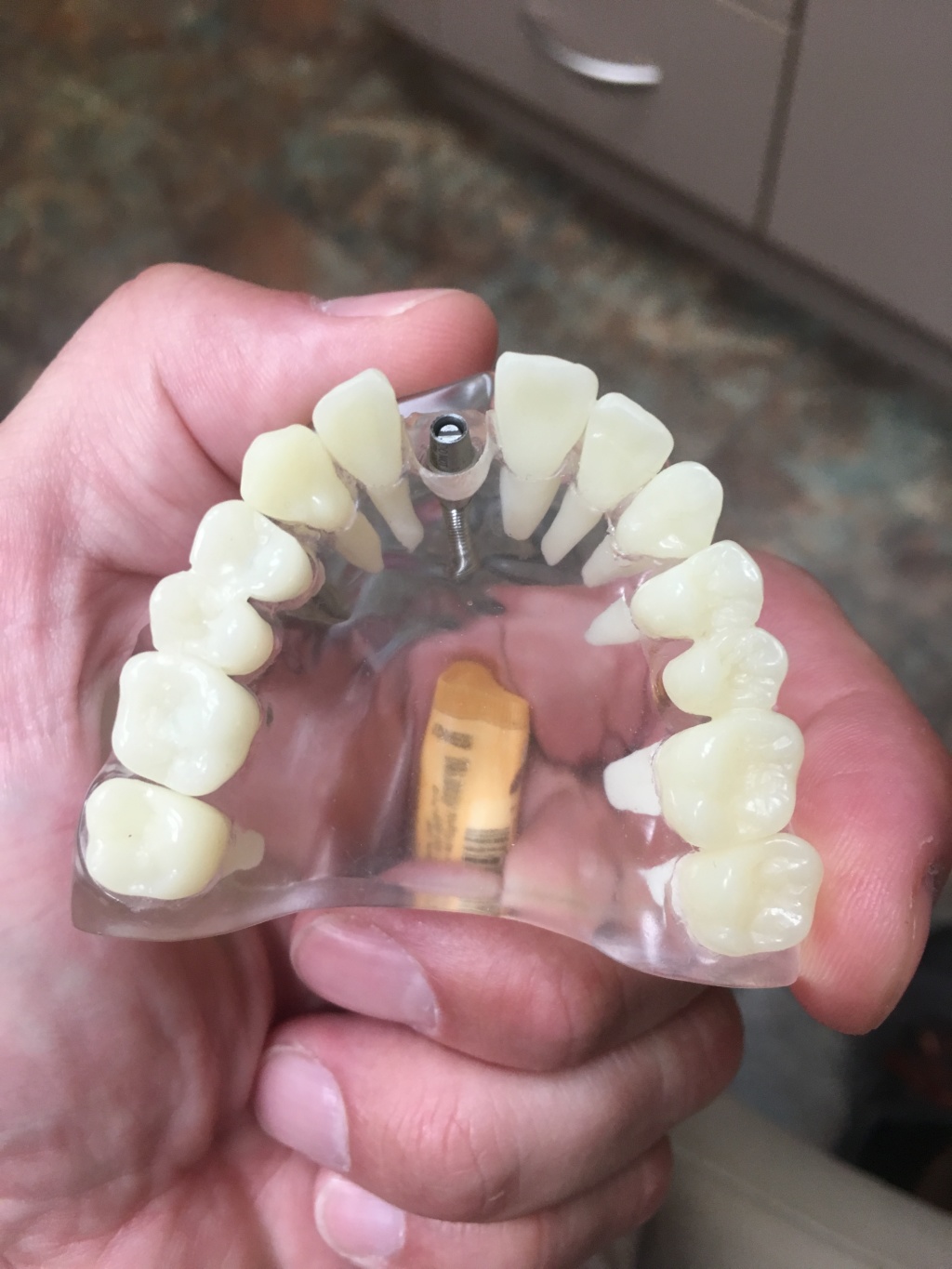2019/09(September)/Broken-Tooth/1024x768_2019-08-26-Broken-crown-1.JPG