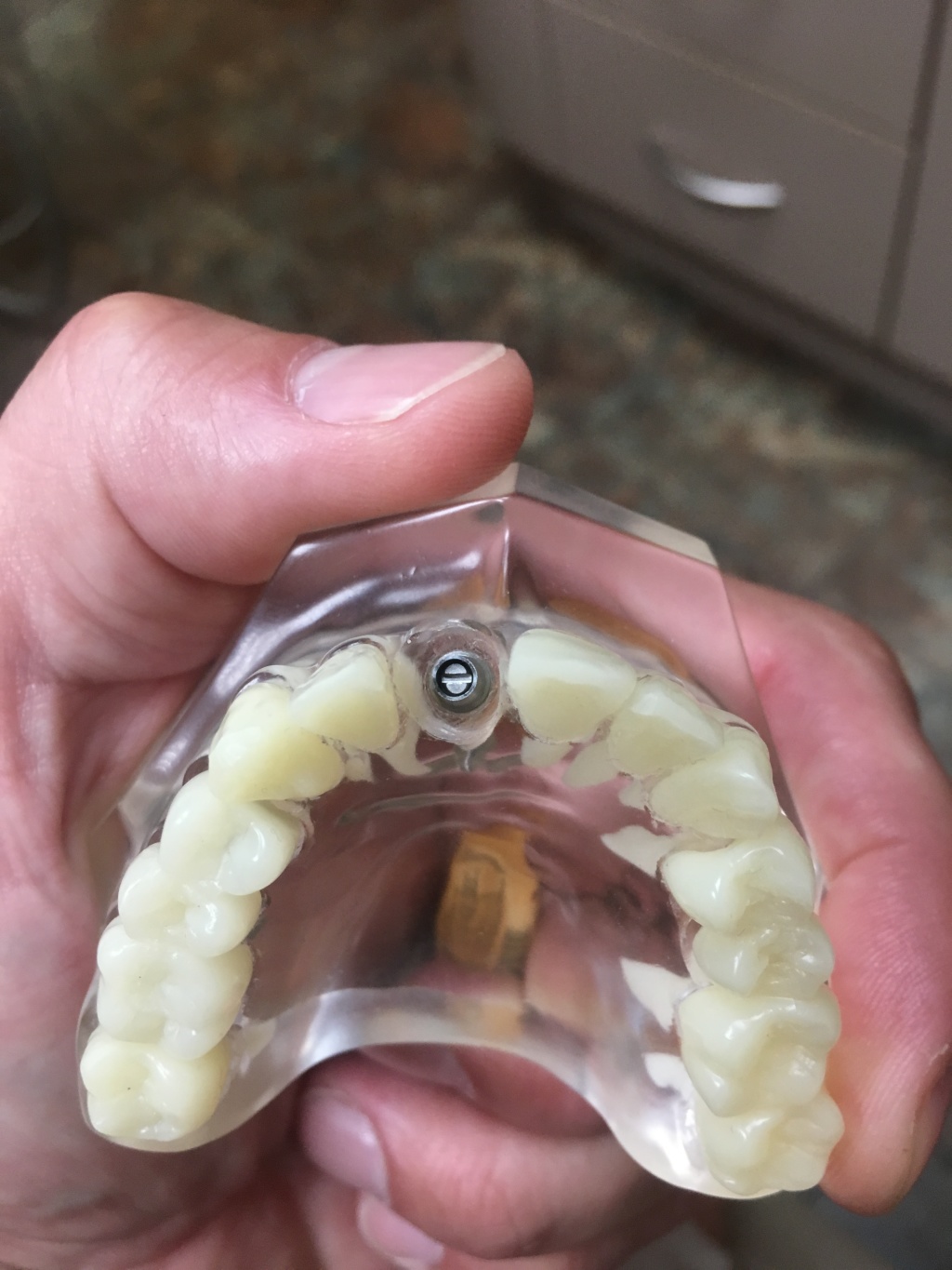 2019/09(September)/Broken-Tooth/1024x768_2019-08-26-Broken-crown-2.JPG