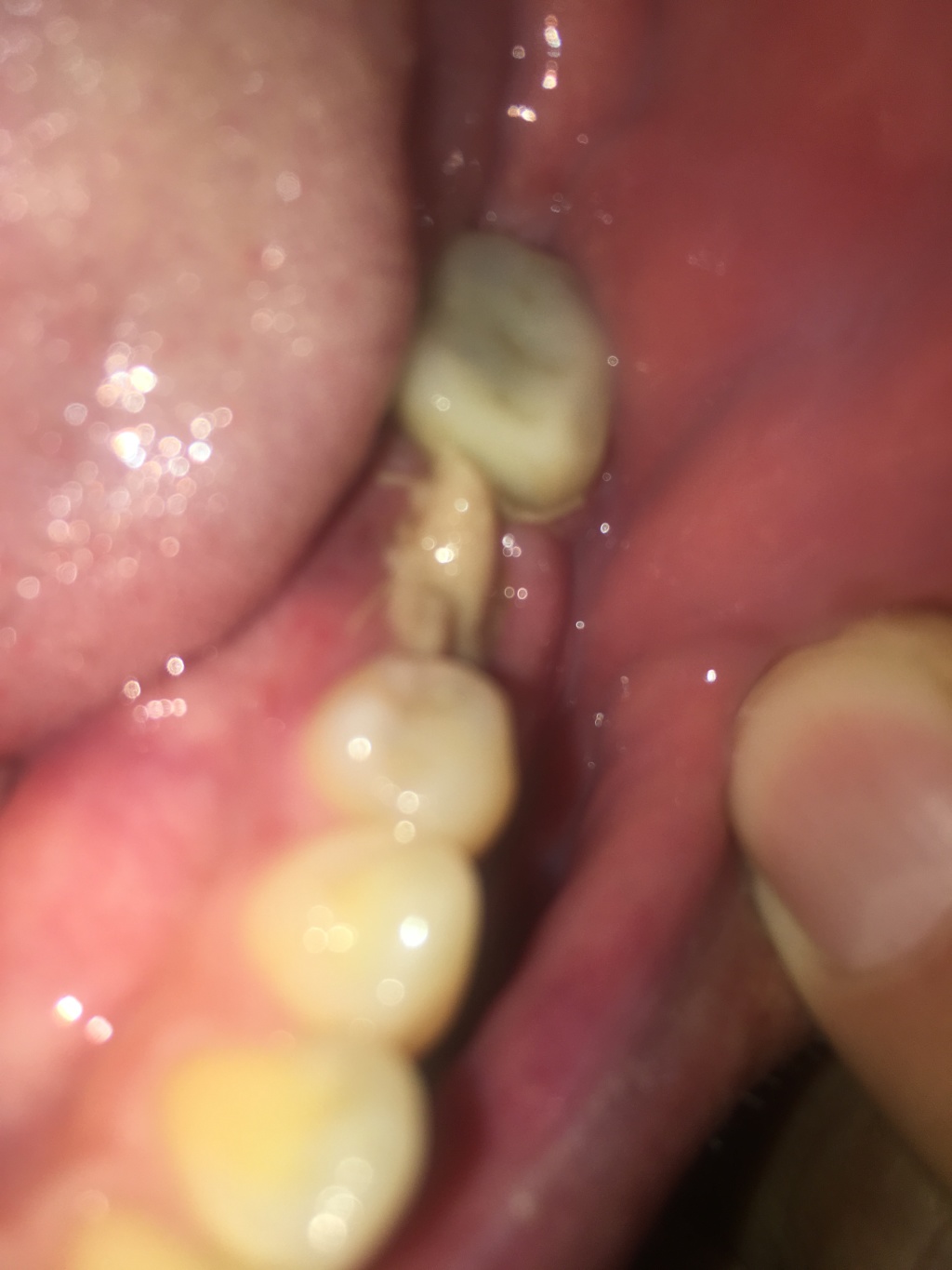 2019/09(September)/Broken-Tooth/1024x768_2019-09-19-Broken-crown-1.JPG