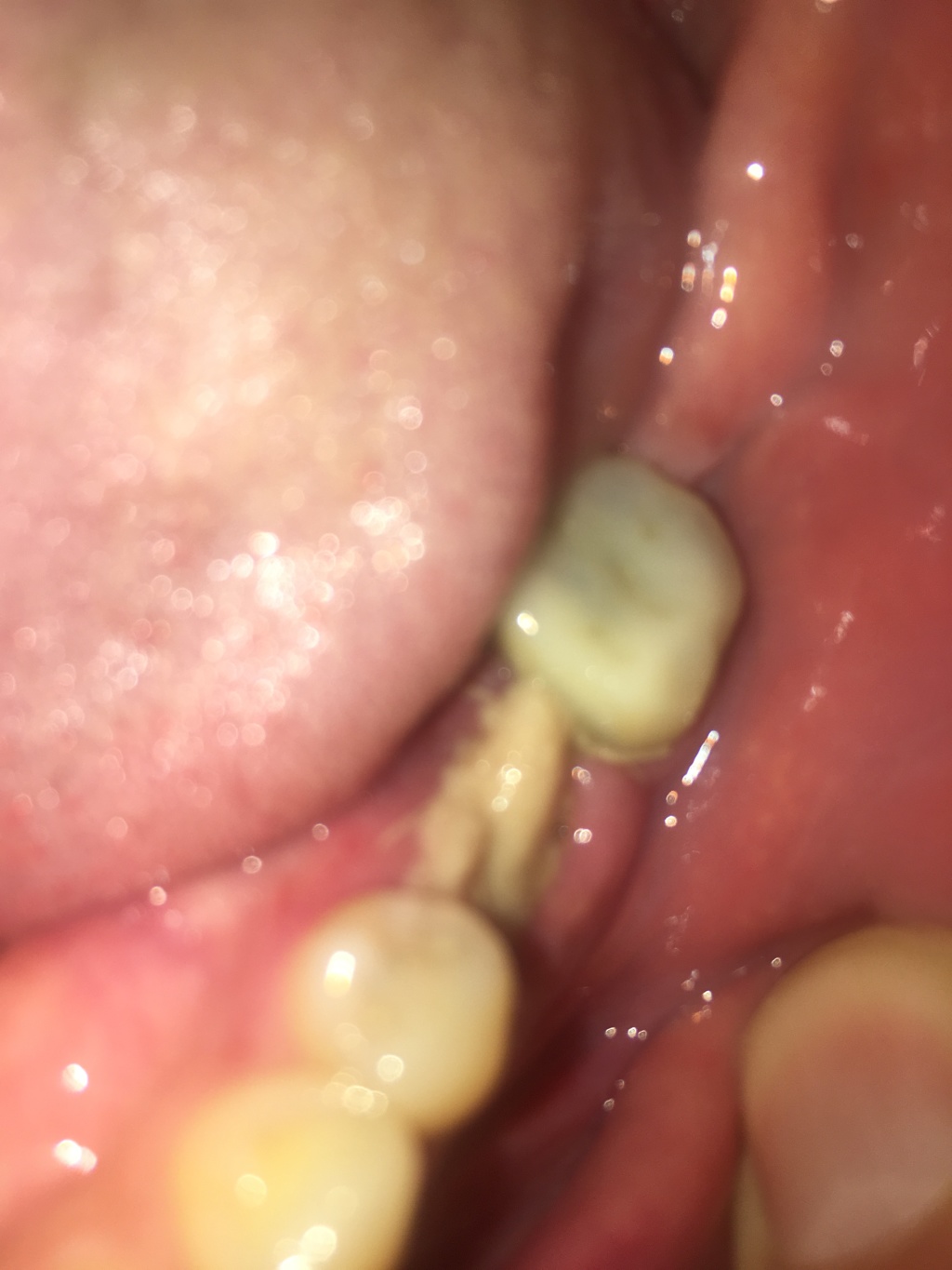 2019/09(September)/Broken-Tooth/1024x768_2019-09-19-Broken-crown-2.JPG