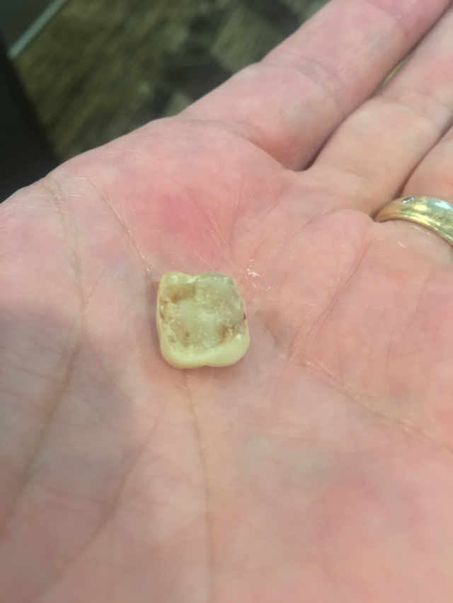 2019/09(September)/Broken-Tooth/640x480_2019-08-20-Broken-crown-2.JPG