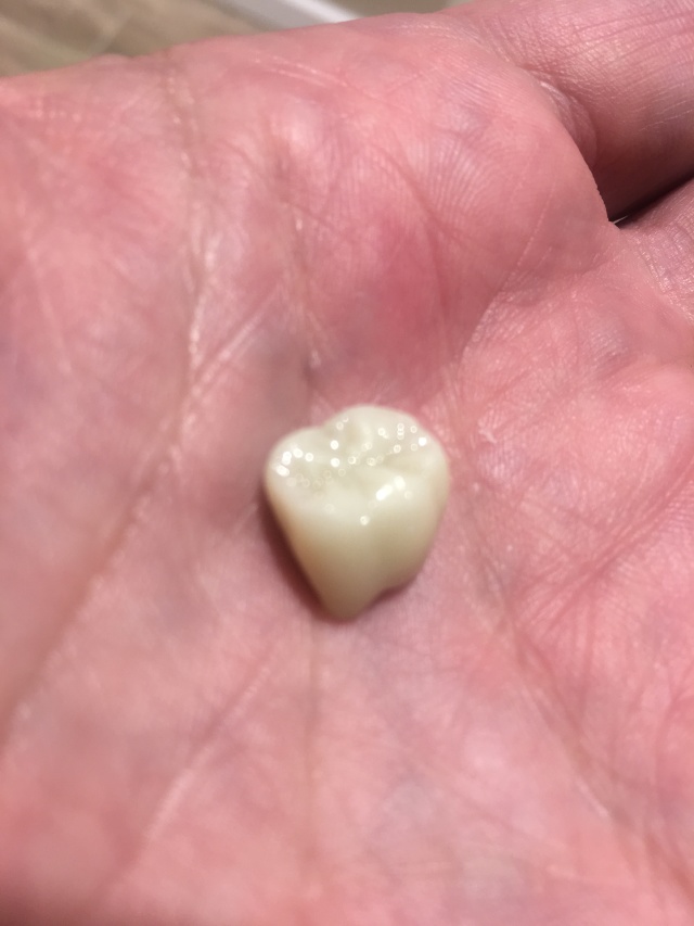 2019/09(September)/Broken-Tooth/640x480_2019-08-20-Broken-crown-3.JPG