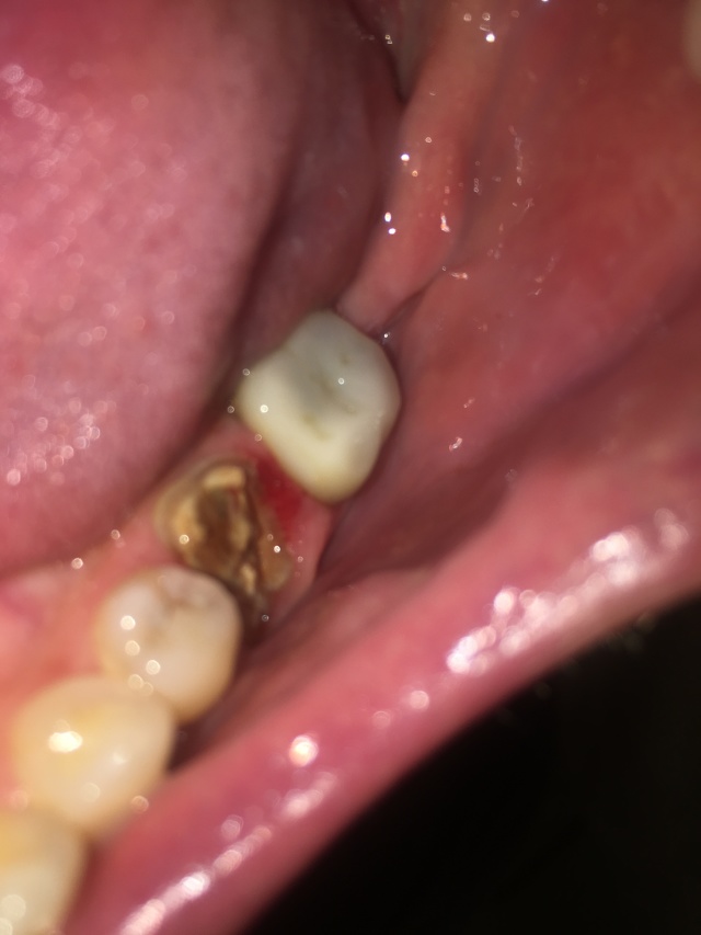2019/09(September)/Broken-Tooth/640x480_2019-08-20-Broken-crown-4.JPG
