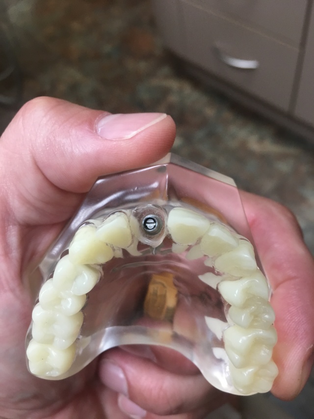 2019/09(September)/Broken-Tooth/640x480_2019-08-26-Broken-crown-2.JPG